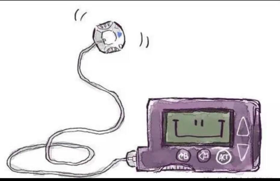 为什么用泵注射胰岛素泵——“泵”出健康_https://www.jmylbn.com_新闻资讯_第3张