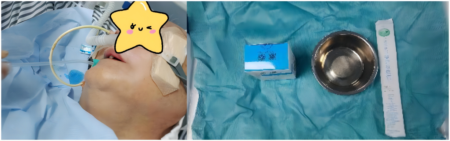 怎么给病人吸痰【健康之窗】“小而不凡”——冲吸式口护吸痰管护佑重症病人口腔健康_https://www.jmylbn.com_新闻资讯_第2张