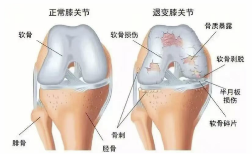 C:\Users\Administrator\Desktop\待发布信息\04 骨科-软骨再生,重塑“膝”望——我院成功为一名15岁患者实施膝关节镜下胶原蛋白软骨修复支架手术\图片\图片1.png C:\Users\Administrator\Desktop\待发布信息\04 骨科-软骨再生,重塑“膝”望——我院成功为一名15岁患者实施膝关节镜下胶原蛋白软骨修复支架手术\图片\图片1.png
