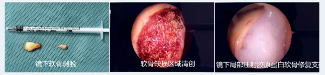 C:\Users\Administrator\Desktop\待发布信息\04 骨科-软骨再生,重塑“膝”望——我院成功为一名15岁患者实施膝关节镜下胶原蛋白软骨修复支架手术\图片\图片4.png C:\Users\Administrator\Desktop\待发布信息\04 骨科-软骨再生,重塑“膝”望——我院成功为一名15岁患者实施膝关节镜下胶原蛋白软骨修复支架手术\图片\图片4.png