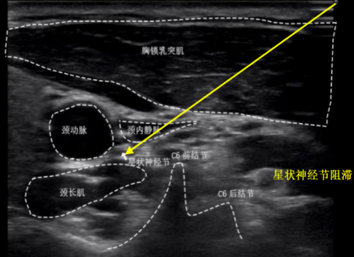 C:\Users\Administrator\Desktop\简讯2篇\微信推送2025年第16期(总第379期)\顽固性失眠——麻醉科有诀窍:星状神经节阻滞为失眠患者开启“安睡开关”\图片\图片2.png C:\Users\Administrator\Desktop\简讯2篇\微信推送2025年第16期(总第379期)\顽固性失眠——麻醉科有诀窍:星状神经节阻滞为失眠患者开启“安睡开关”\图片\图片2.png