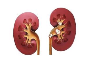 C:\Users\Administrator\Desktop\微信推送2025年第51期（总第414期）\04 肾内科-疼到直不起腰？小心身体里长了 “小石头”！\图片\图片1.jpg