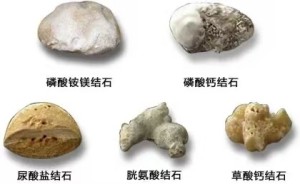 C:\Users\Administrator\Desktop\微信推送2025年第51期（总第414期）\04 肾内科-疼到直不起腰？小心身体里长了 “小石头”！\图片\图片2.jpg